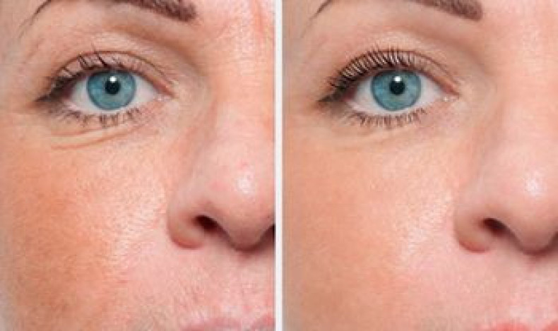 Мезотерапія в салоні краси Візард Київ