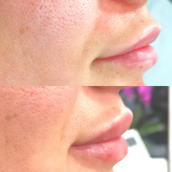 Збільшення губ філлером на основі гіалуронової кислоти 1 мл