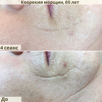 Коррекция морщин