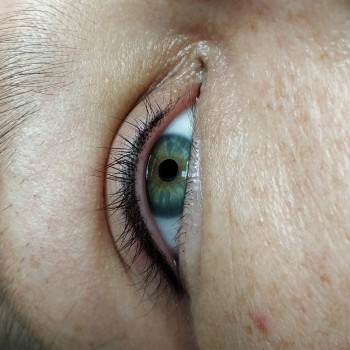 Межресничка.