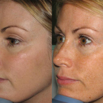 Фотоомолодження
                    Салон красоты Wizard Киев