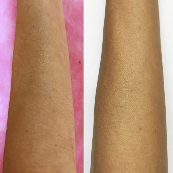 Лазерная эпиляция рук
                    Косметологический центр Body House Киев