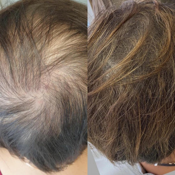 Трихопигментация
                    Лікар-косметолог Юлия Харків