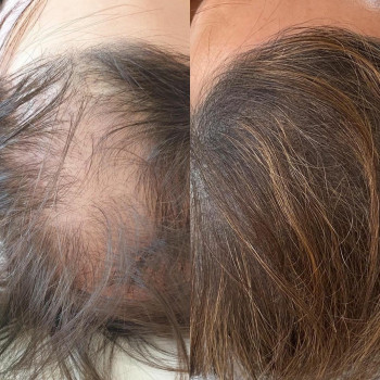 Трихопигментация
                    Лікар-косметолог Юлия Харків