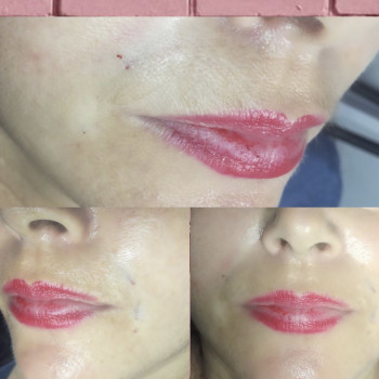 Заповнення носогубних складок
                    Косметолог-инъекционист Марина Днепр