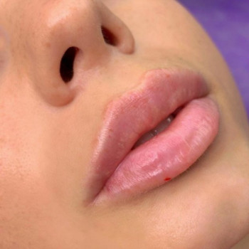 Коррекция губ