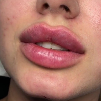 Коррекция губ