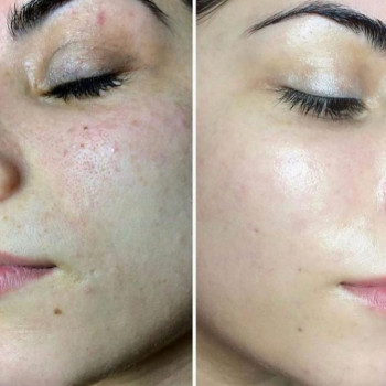 Чистка +пилинг