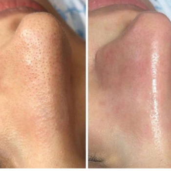 Чистка лица