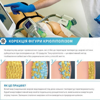 Кріоліполіз