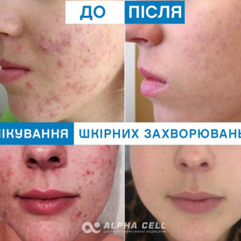 Плазмоліфтинг