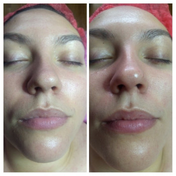 Экспресс - Детокс. Глубокое очищение лица
                    Косметолог Светлана Дніпро