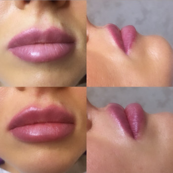 Контурная пластика губ препаратом Юведерм 0,55мл