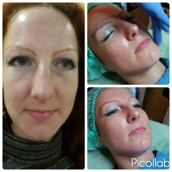  
Неровный цвет лица
До и после процедуры