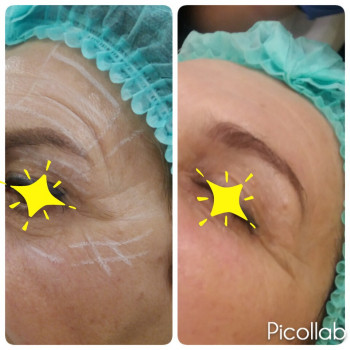  
 
65лет 
До и сразу После Смас