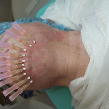 Укрепляем подбородок мезонитями