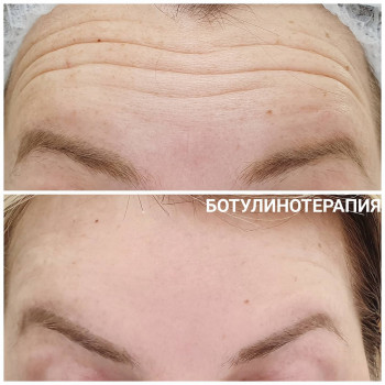 Ботулинотерапия