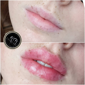 Увеличение губ