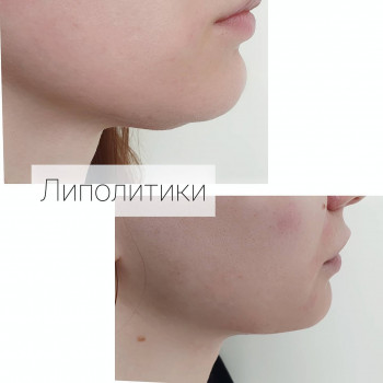 Липолитики, устранение второго подбородка