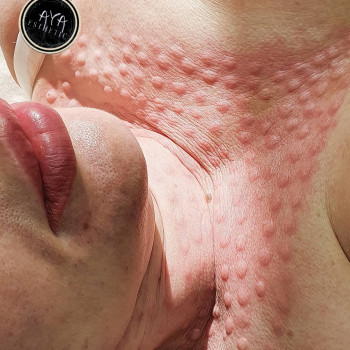 Биоревитализации