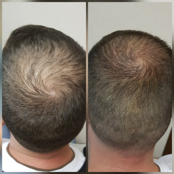 Загущення волосся. Результат за одну процедуру.