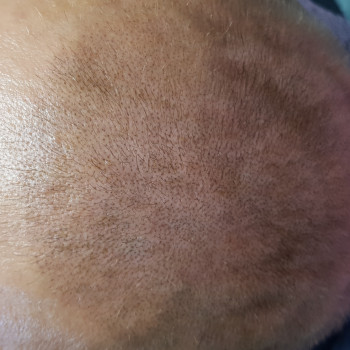 Трихопігментація на повній алопеції голови