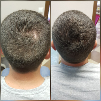 Закриття шраму голови. Результат за одну процедуру.