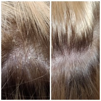 Лечение сибореи