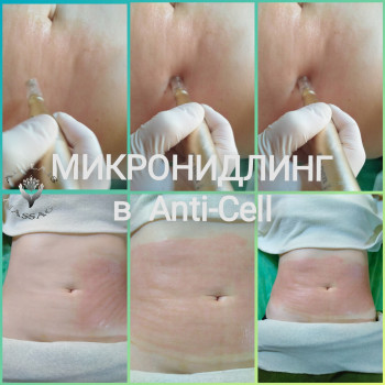 Мікронідлінг (фракційна мезотерапія)
                    Масажист Юлія Київ