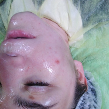 1й сеанс карбокси