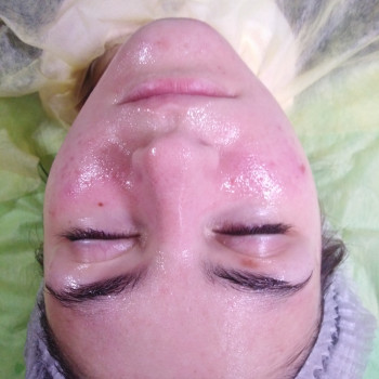 Карбокси для проблемной кожи