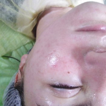 1й сеанс после процедуры