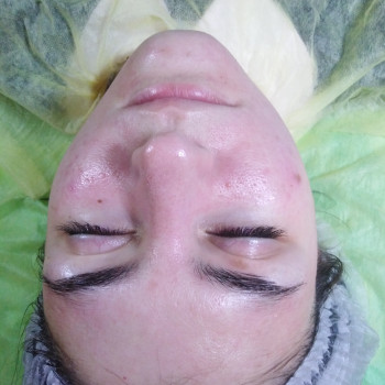 Карбокситерапия
                    Массажист Юлія Киев