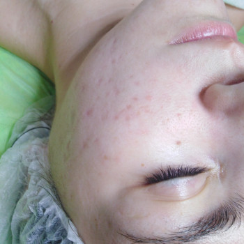 3й сеанс карбокси