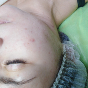 Карбокситерапия
                    Массажист Юлія Киев