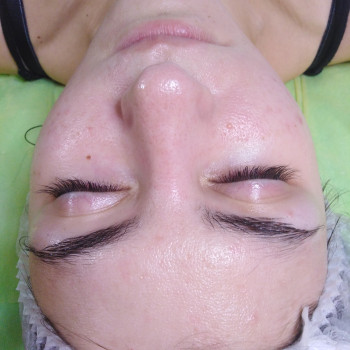 после процедуры