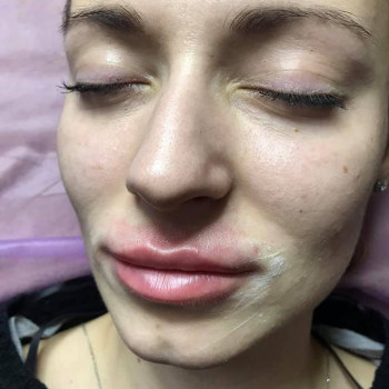 Увеличения объёма губ