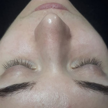 Чистка лица