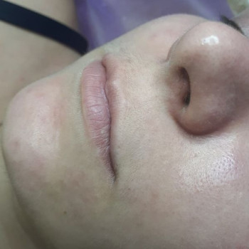 Депиляция усиков