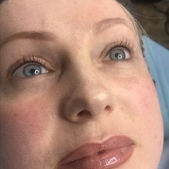 Межресничка Херсон