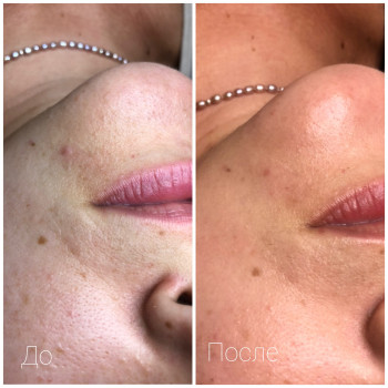 Комбинированная чистка