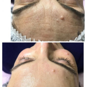 Биоревитализация и БТА