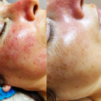 Лечение купероза и уменьшение морщин.