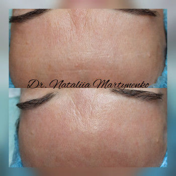 Ботокс и биоревитализация