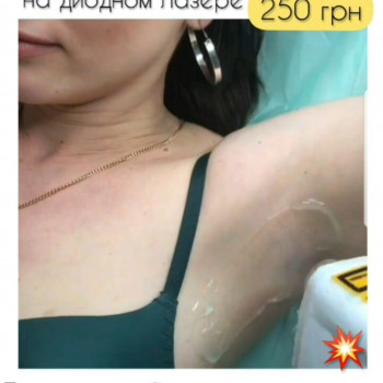 Лазерна епіляція (діодний лазер)
                    Салон красоты Beauty Line Запорожье