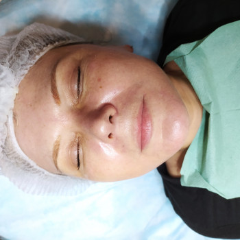 Пілінг
                    Лікар-косметолог Тетяна Луцьк