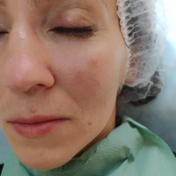 Пілінг
                    Лікар-косметолог Тетяна Луцьк