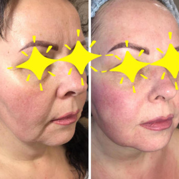 Комплекс "Фракционный RF-лифтинг" лица БЕЗ проколов кожи
                    Косметолог Ирина Киев