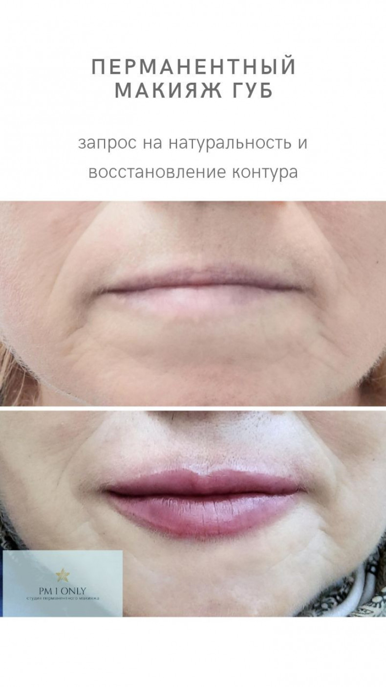 Восстановление контура и цвета возрастных губ, фото -  