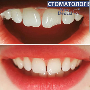 реставрация зубов